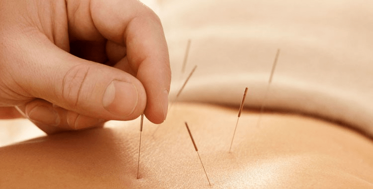 acupuncture contre le tabagisme